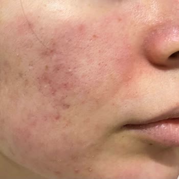 Sinoz Güneş Koruyucu Cildimde Alerji Ve Sivilceye Sebep Oldu