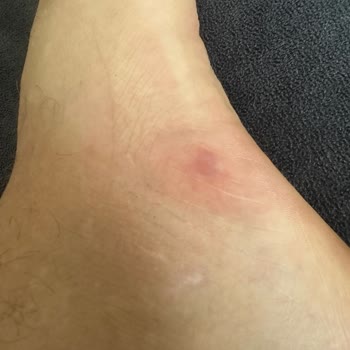 Pahalı Crocs Terlik Ayağımı Kızarttı, Mağaza Sorumluluk Almadı