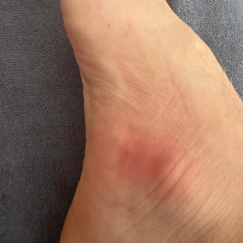 Pahalı Crocs Terlik Ayağımı Kızarttı, Mağaza Sorumluluk Almadı