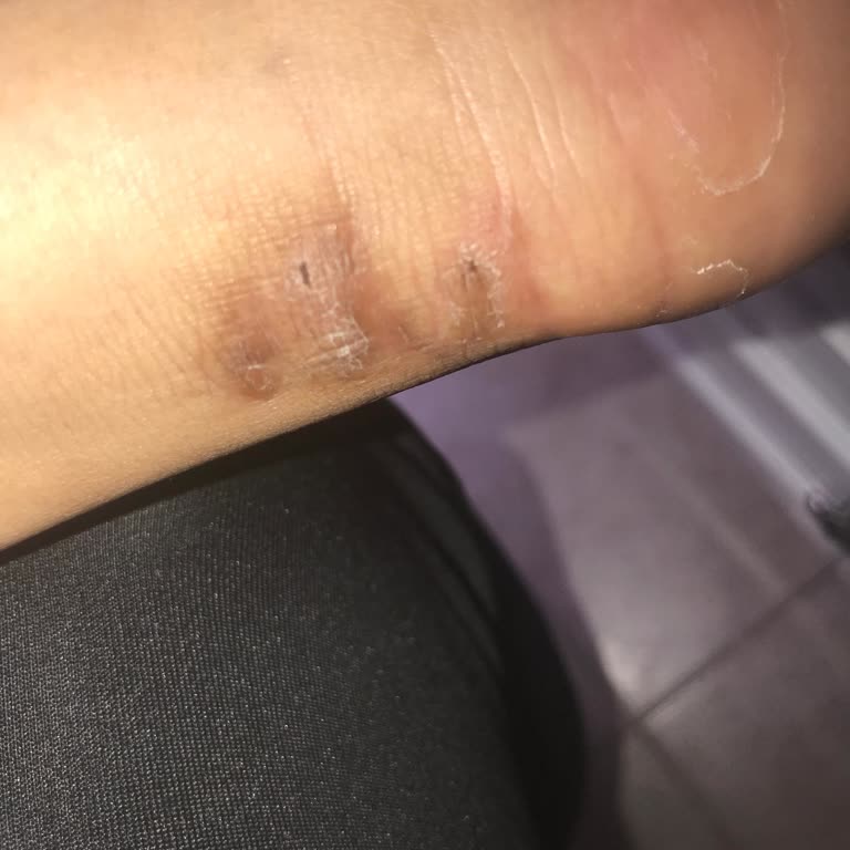 Aldığım Adidas Ayakkabı Ayağımda Sağlık Sorunlarına Yol Açtı, İade Talebim Reddedildi