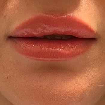 Dudakta Yamuk Ve Topaklanan Dolgu Sonrası Memnuniyetsizlik