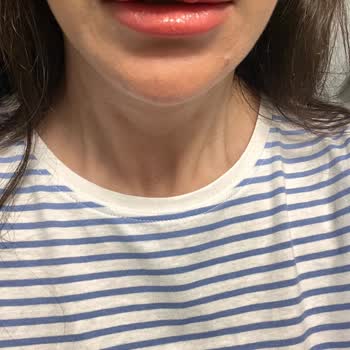 Dudakta Yamuk Ve Topaklanan Dolgu Sonrası Memnuniyetsizlik