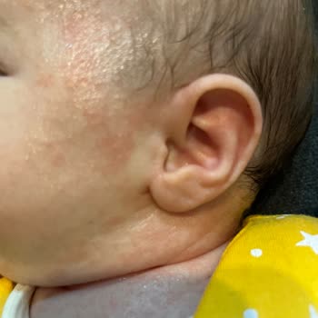 Mustela Krem Sonrası Bebeğimde Kızarıklık Ve Huzursuzluk Oluştu