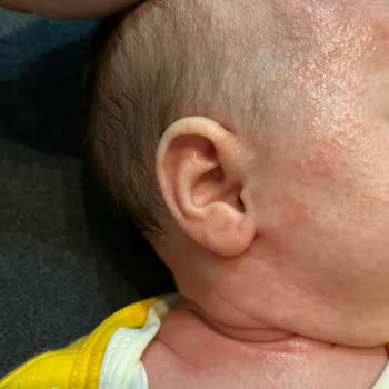 Mustela Krem Sonrası Bebeğimde Kızarıklık Ve Huzursuzluk Oluştu