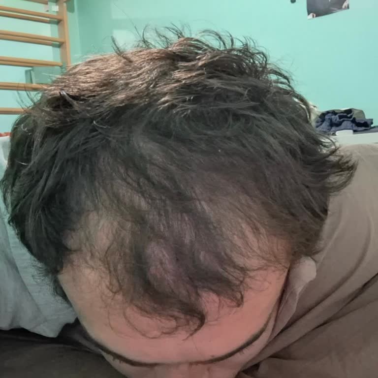 Doktorsitesi.com Doktorun Tedavisiyle Kilo Artışı Ve Saç Kaybı Yaşadım