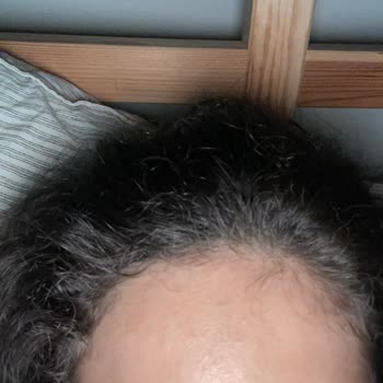 Yanlış Ürün Önerisi Sonucu Ciltte Alerji Ve Sivilce Sorunu