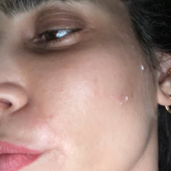 Yanlış Ürün Önerisi Sonucu Ciltte Alerji Ve Sivilce Sorunu