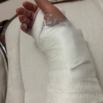 Kaygan Engelli Rampası Yüzünden Kolum Kırıldı!