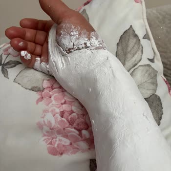 Kaygan Engelli Rampası Yüzünden Kolum Kırıldı!