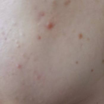 Bioderma Atoderm Cream Sonrası Yüzümde Kalıcı Sivilce Ve Komedonlar Oluştu