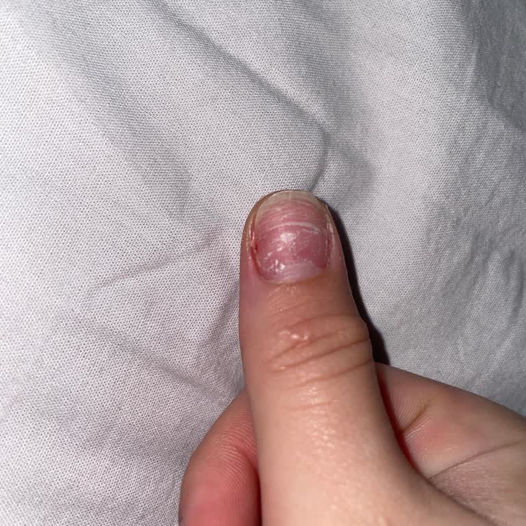 Takma Tırnak Uygulaması Sonrası Yaşadığım Ciddi Mağduriyet