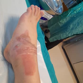 Seyahat Sırasında Şoförün Dikkatsizliği Sonucu Eşimin Ayağı Yandı, Firma Sorumluluğu Üstlenmiyor