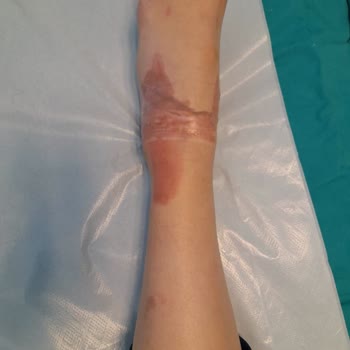 Seyahat Sırasında Şoförün Dikkatsizliği Sonucu Eşimin Ayağı Yandı, Firma Sorumluluğu Üstlenmiyor