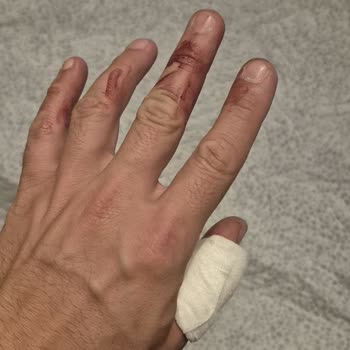 Acil Durumda Sağlık Sigortası Ameliyat Onayı Gecikti, Tedavi Reddedildi