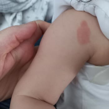 Ena Farma Cold Mix Vücutta Yanığa Sebep Oldu