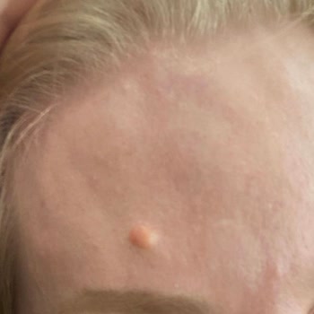 Botoks Sonrası Uzun Süreli Şişlik Ve İlgisiz Klinik Deneyimi