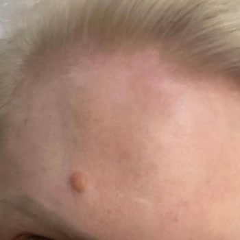 Botoks Sonrası Uzun Süreli Şişlik Ve İlgisiz Klinik Deneyimi