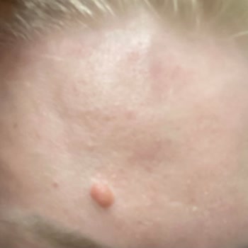 Botoks Sonrası Uzun Süreli Şişlik Ve İlgisiz Klinik Deneyimi