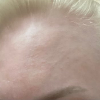 Botoks Sonrası Uzun Süreli Şişlik Ve İlgisiz Klinik Deneyimi