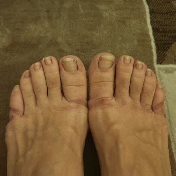 Rahat Denilen Ayakkabı 5 Dakikada Parmaklarımı Yaraladı İade Talebim Reddedildi