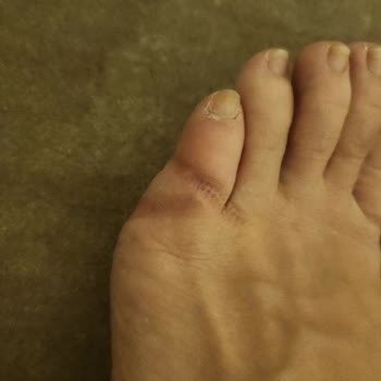 Rahat Denilen Ayakkabı 5 Dakikada Parmaklarımı Yaraladı İade Talebim Reddedildi