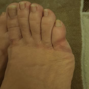 Rahat Denilen Ayakkabı 5 Dakikada Parmaklarımı Yaraladı İade Talebim Reddedildi