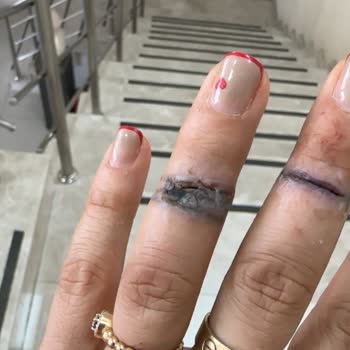 Esse Life İzmir Yanlış Uygulama Sonucu Parmağımda Ciddi Hasar Oluştu