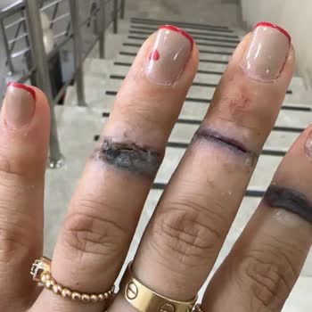 Esse Life İzmir Yanlış Uygulama Sonucu Parmağımda Ciddi Hasar Oluştu