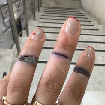 Esse Life İzmir Yanlış Uygulama Sonucu Parmağımda Ciddi Hasar Oluştu