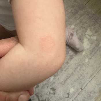 Bebek Şampuanı Sonrası Ciltte Egzama Ve Döküntü Sorunu