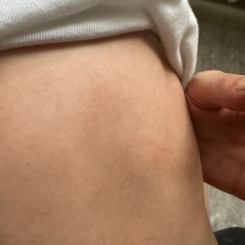 Bebek Şampuanı Sonrası Ciltte Egzama Ve Döküntü Sorunu