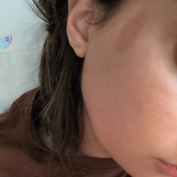 Kuaförde Kimyasal Yanık Sonrası İlgisizlik Ve Yüzümde İz Kaldı