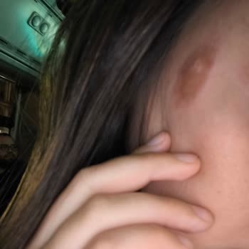 Kuaförde Kimyasal Yanık Sonrası İlgisizlik Ve Yüzümde İz Kaldı