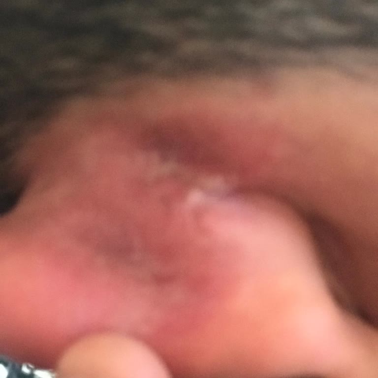 Selvors Bant Kullanımı Sonrası Kulak Arkasında Yara Oluştu