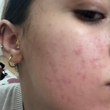 Cilt Ürünleri Sonrası Cilt Sağlığım Bozuldu