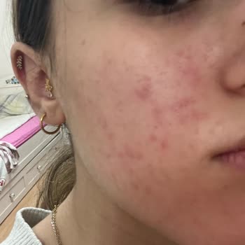 Cilt Ürünleri Sonrası Cilt Sağlığım Bozuldu