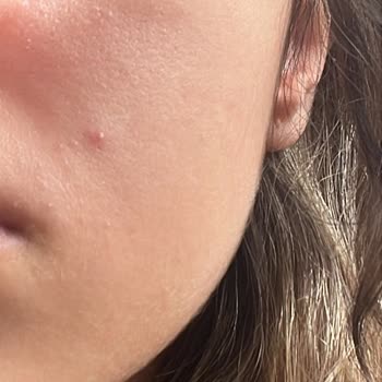 Cilt Ürünleri Sonrası Cilt Sağlığım Bozuldu