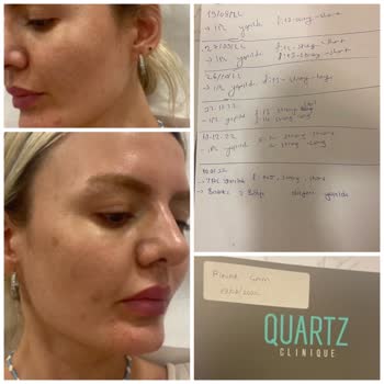 IPL Tedavisi Sonuçsuz Kaldı, Lekelerim Geçmedi