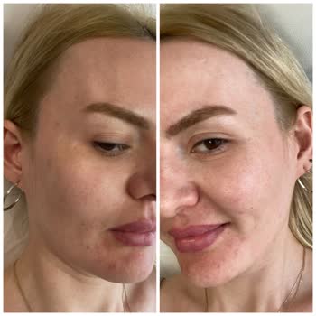 IPL Tedavisi Sonuçsuz Kaldı, Lekelerim Geçmedi