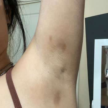 Estetik İşlem Sonrası Koltuk Altımda Kararma Ve Leke Oluştu