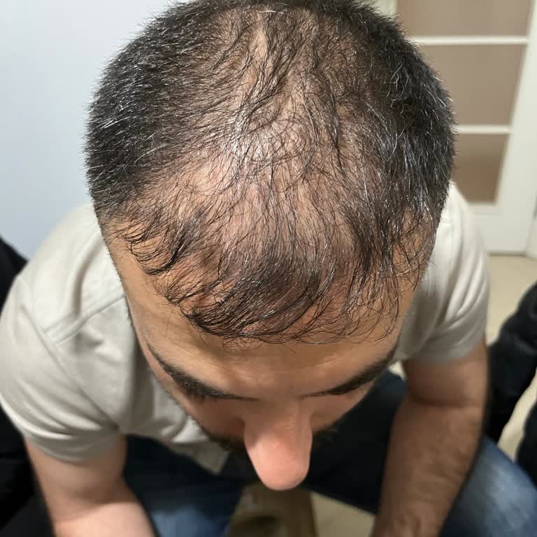 HairCenter Saç Ekiminde Ödediğimiz Ücretin Daha Yüksek Rakamını Bizden Talep Etti