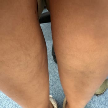 Manuel Terapi Sonrası Oluşan Dolaşım Sorunu Ve İlgisizlik