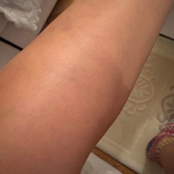 Manuel Terapi Sonrası Oluşan Dolaşım Sorunu Ve İlgisizlik