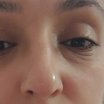 Garnier C Vitaminli Maske Sonrası Göz Altında Şiddetli Şişlik