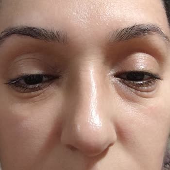 Garnier C Vitaminli Maske Sonrası Göz Altında Şiddetli Şişlik
