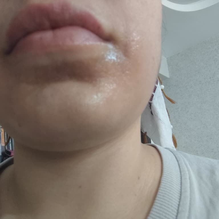 Golden Güzellik Yosun Peelingi Sonrası Yüzümde Yanık Ve Kararma Oluştu