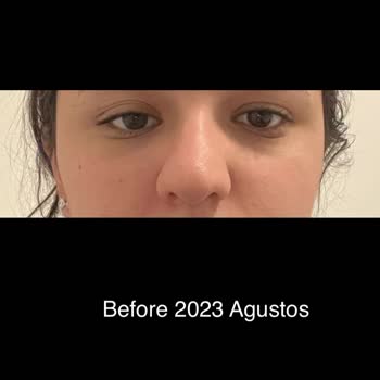 Burun Ameliyatı Sonrası Yaşadığım Mağduriyet Ve İlgisiz Yaklaşım