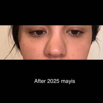 Burun Ameliyatı Sonrası Yaşadığım Mağduriyet Ve İlgisiz Yaklaşım