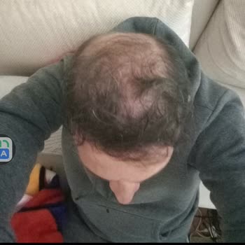 Estenivo Saç Ekimi Sonrası İlgisizlik Ve Para İadesi Taleplerim Yanıtsız Kaldı