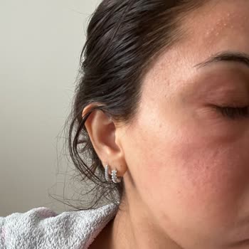Bee Beauty Maske Sonrası Ciltte Şiddetli Alerjik Reaksiyon